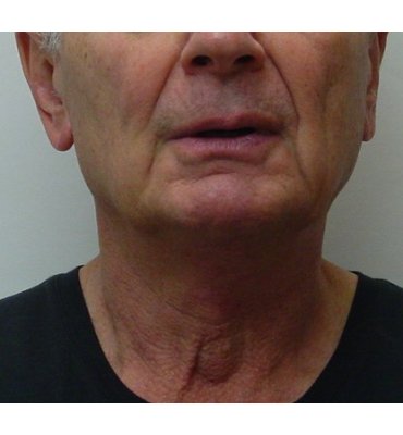 neck lift no scars